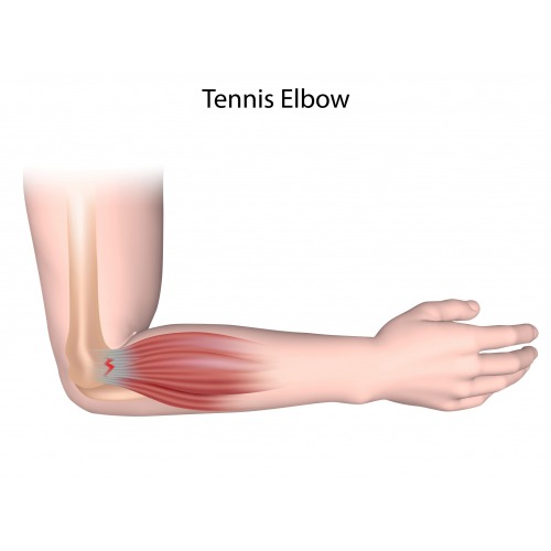 Case Study :Tennis Elbow  Pain Relief 